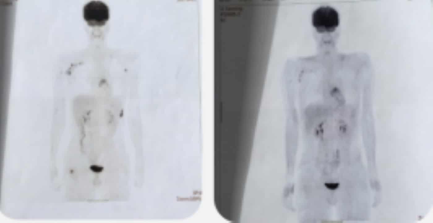 Whole body radiological images of a 20-year-old male in complete remission 1.5-years post-infusion, from refractory relapsed Hodgkin’s lymphoma.